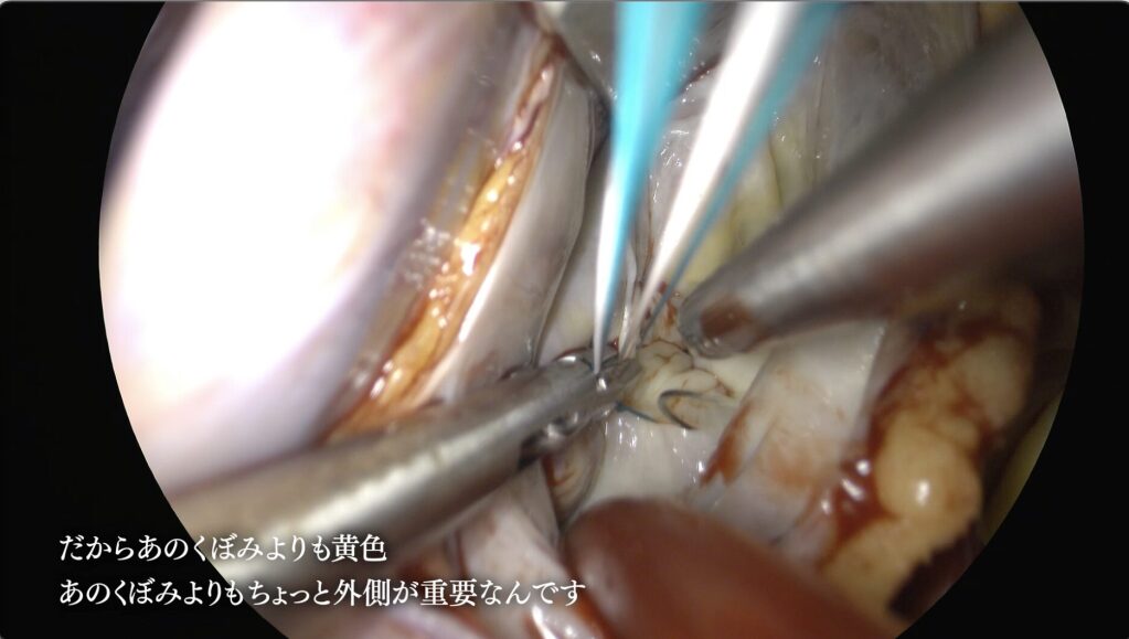 0402　BS1 8K医療改革最前線2023　にて弊社映像と淺香時夫学術顧問出演